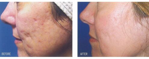 Before and after applying the laser device on the skin with scars