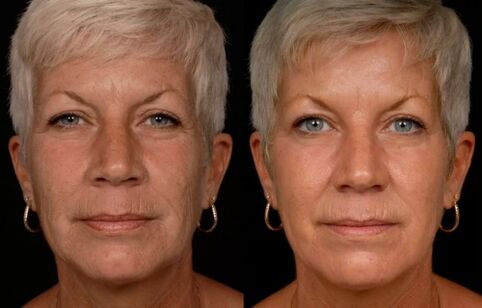 Result of laser treatment of facial skin - reduction of wrinkles