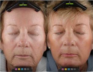 Before and after rejuvenation with a fractional laser