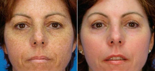 fractional resurfacing