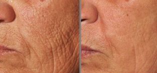 photo before and after partial skin rejuvenation